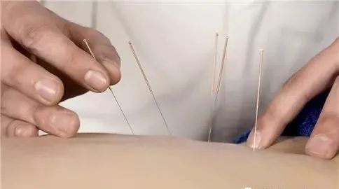 针灸减肥的三大常见误区
