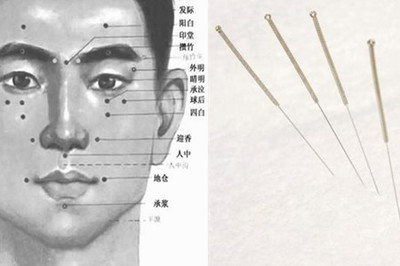 针灸治疗面瘫 传统医学的现代实证与显著疗效