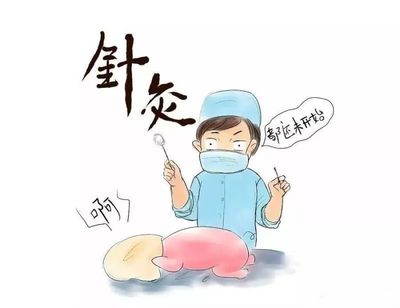 不疼的针灸 探索筋针疗法的独特魅力